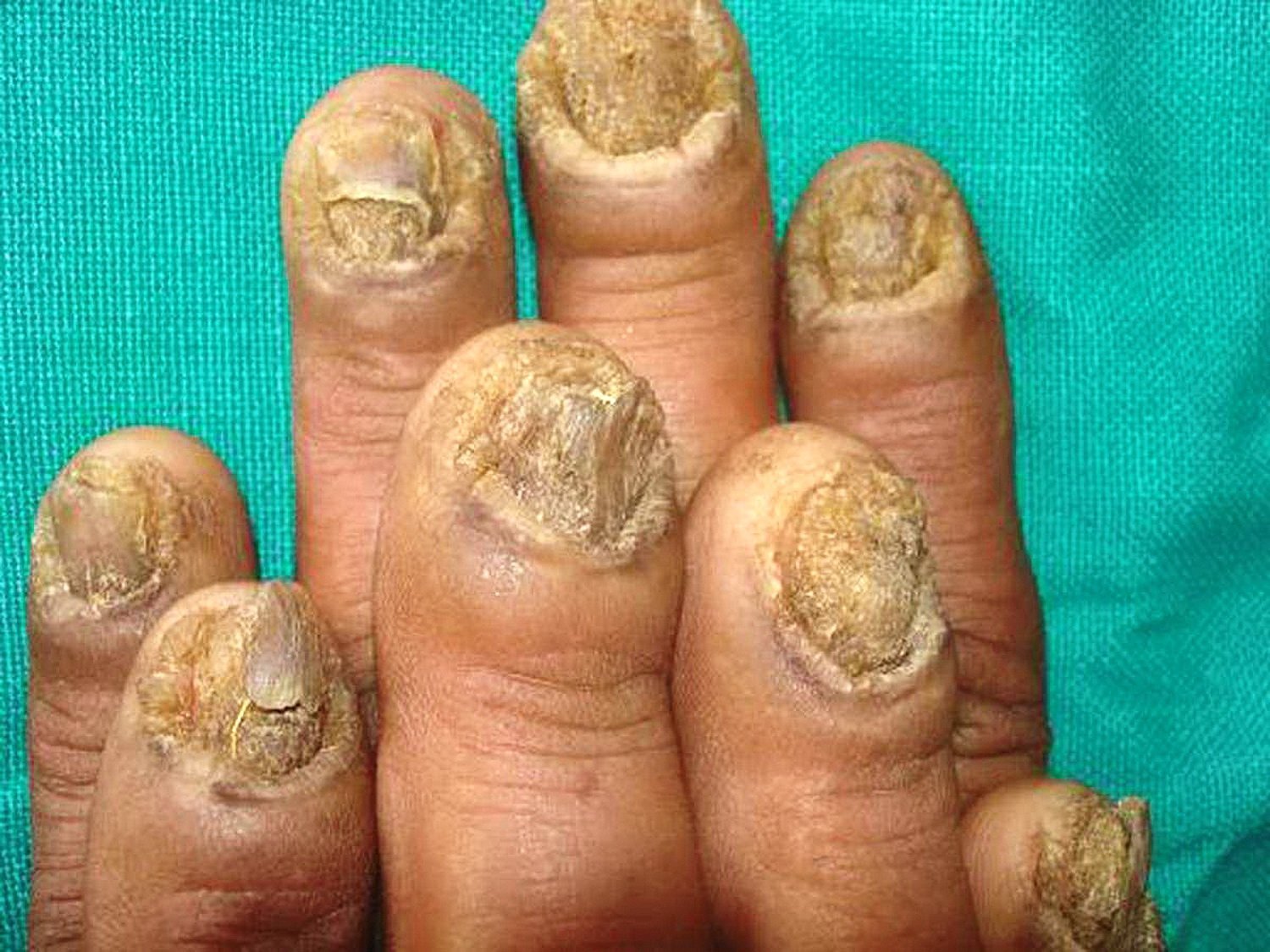 medicina-online-onicomicosi-micosi-unghie-immagine-10.jpg